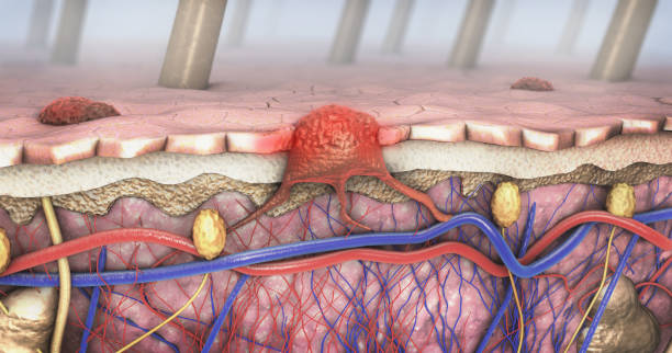 3d ilustracja przekroju chorej skóry z czerniakiem, który dostaje się do krwiobiegu i przewodu chłonnego - melanoma mole human skin dermatology zdjęcia i obrazy z banku zdjęć