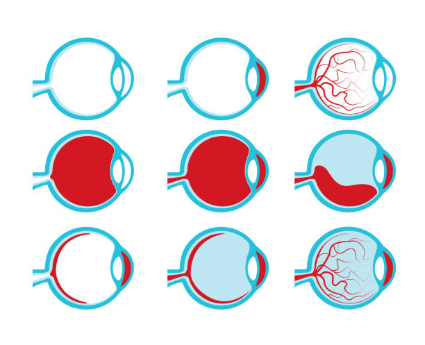 illustrations, cliparts, dessins animés et icônes de illustration de vue latérale des yeux humains sains et malsains cross iris santé, médial de section - choroid