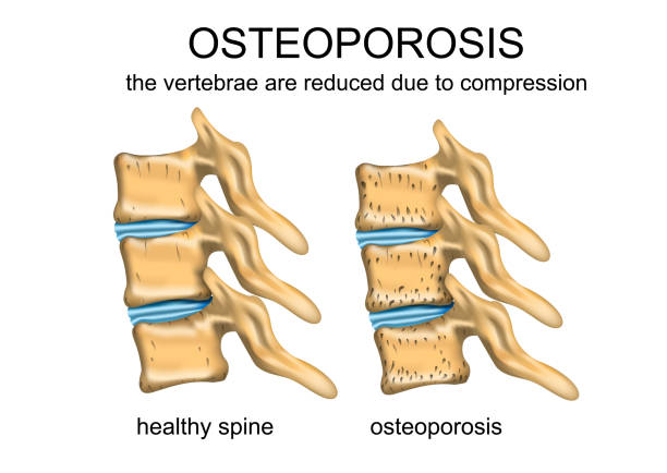 illustrazioni stock, clip art, cartoni animati e icone di tendenza di colonna vertebrale sana e osteoporosi - backache pain physical injury sport
