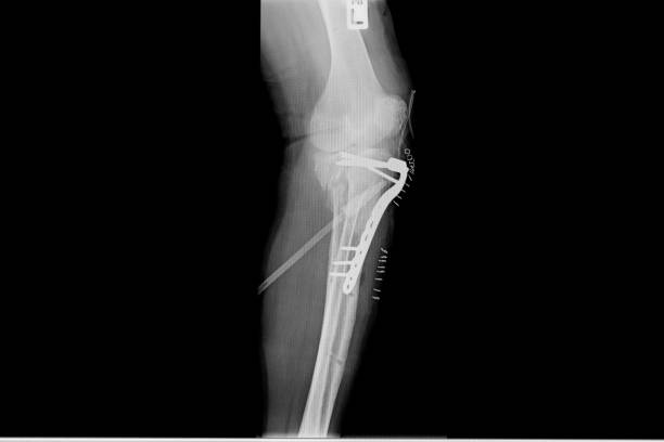 istock internal of left leg fixed with plate and screws. 1085913926
