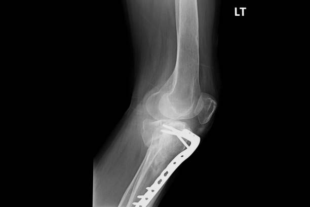 istock internal of left leg fixed with plate and screws. 1085913946