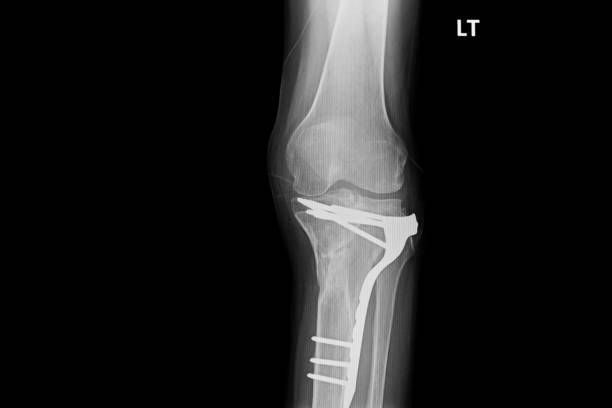 istock internal of left leg fixed with plate and screws. 1085913948