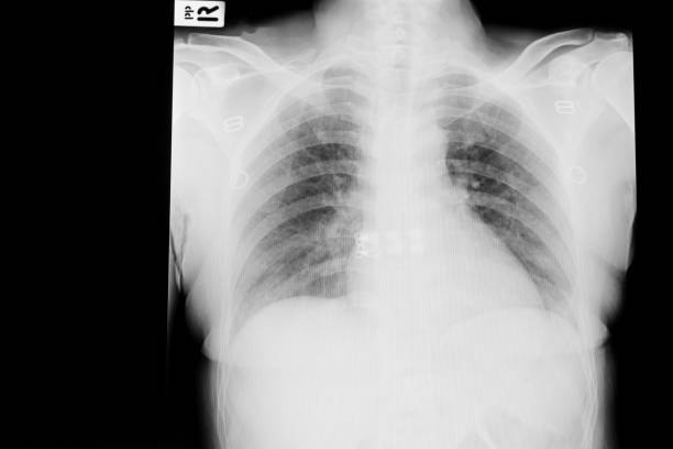 istock Normal chest x-ray image demonstrated heart,lungs,ribs,bones and muscles 1085913972
