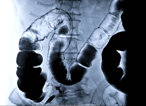 バリウム浣腸画像はバリウム コントラストの直腸注入です。これは、コートの大腸の粘膜と直腸とレントゲン透視制御の下で得られます。 - barium ストックフォトと画像