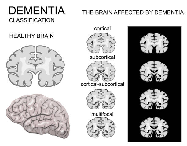 치 매, alzheimer 질병 및 그것의 분류입니다. 신 경계 - medulla oblongata stock illustrations