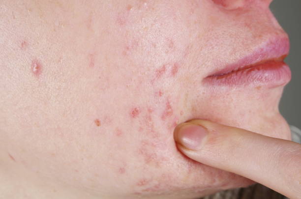 istock Cropped Image Of Woman Face With Pimples 1086092638