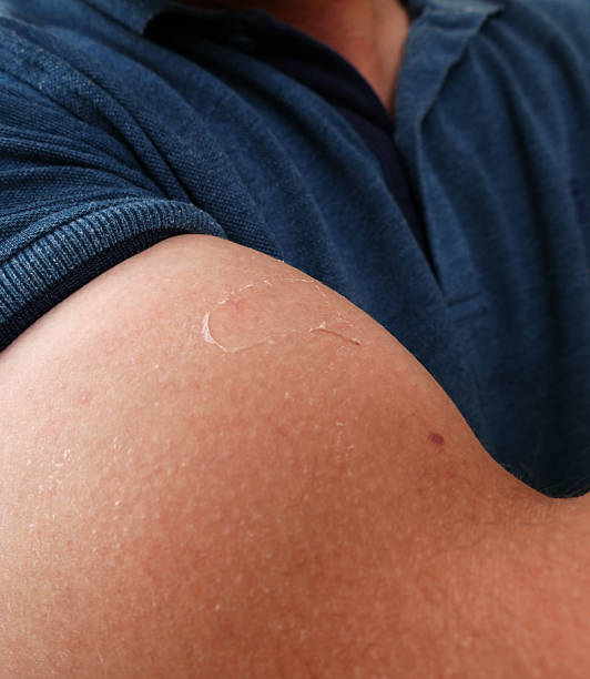 istock sunburns, the sun's burning a human skin, 1086427168