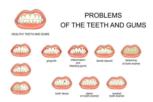 zdrowe dziąsła i zęby oraz choroby jamy ustnej - human teeth gums dental hygiene inflammation stock illustrations