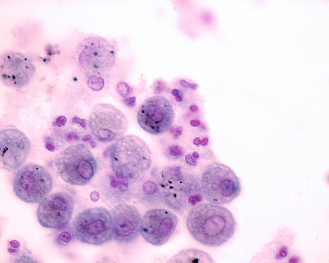 High magnification showing large rounded alveolar macrophages showing foamy cytoplasm and some anthracotic pigment granules.