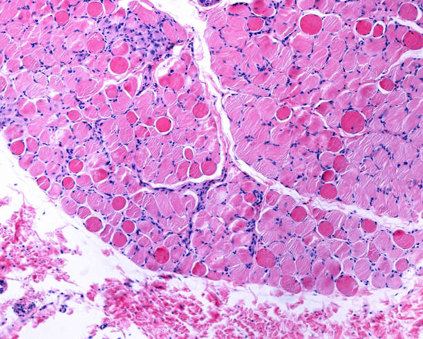 fibra del músculo necrótica. duchenne distrophy - micrografía de luz fotografías e imágenes de stock