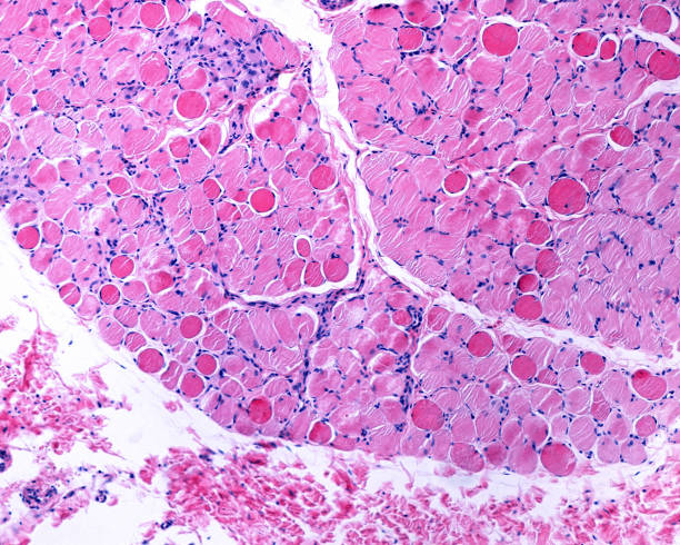 Necrotic muscle fiber. Duchenne distrophy The key pathologic change of the Duchenne muscular dystrophy is the myonecrosis. At an early phase, necrotic fibers appear swollen, homogeneous and deeply eosinophilic. This disease is caused by mutations of dystrophin, the largest known human gene, located on chromosome Xq21. light micrograph photos stock pictures, royalty-free photos & images