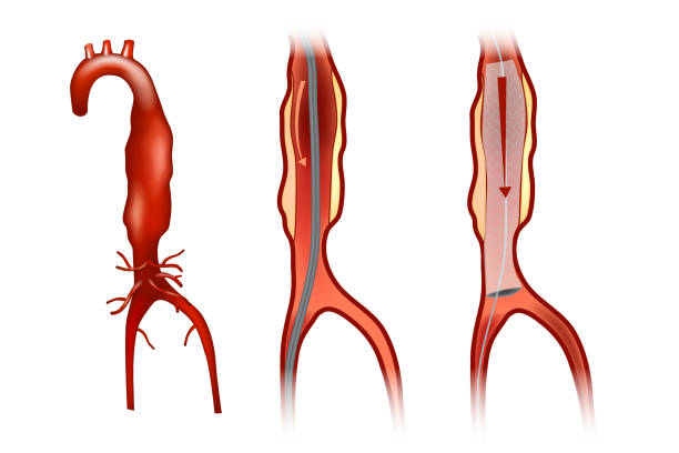 illustrazioni stock, clip art, cartoni animati e icone di tendenza di riparazione dell'aneurisma endovascolare - aorta