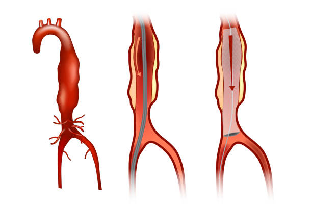 эндоваскулярная аневризма ремонт - human artery illustrations stock illustrations
