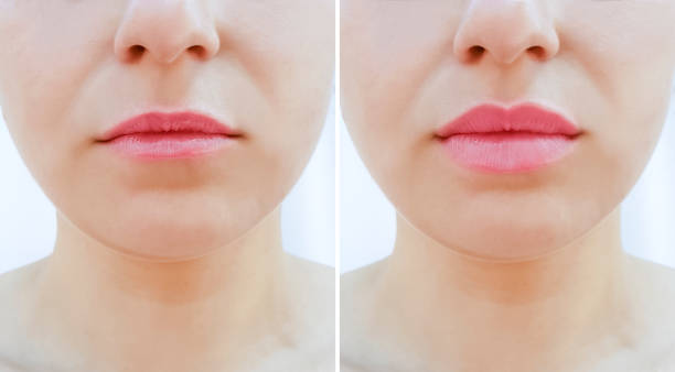 girl lips before and after magnification girl lips before and after magnification big fat lips stock pictures, royalty-free photos & images