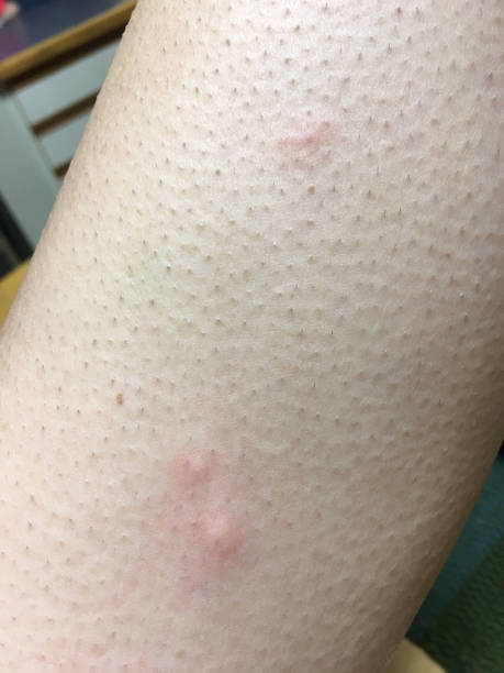 mosquito pica en la pierna de la mujer golpea del ganso - piel de gallina fotografías e imágenes de stock