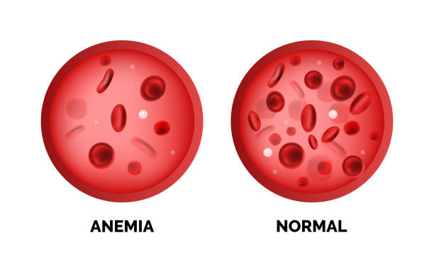 infografik-bild einer anämie isoliert auf weißem hintergrund - anemia stock-grafiken, -clipart, -cartoons und -symbole
