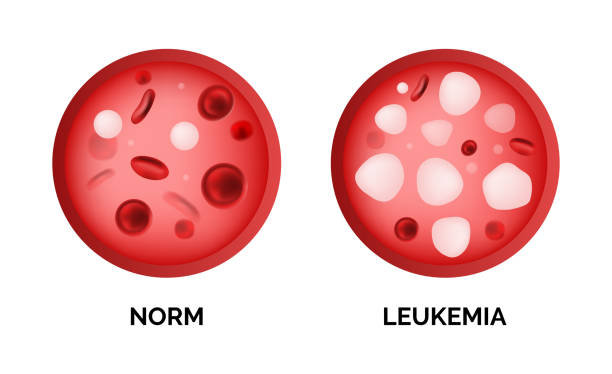 Infographic image of leukemia, lukemia or leukaemia isolated Infographic image of leukemia, lukemia or leukaemia isolated on white background. Realistic vector 3d picture of blood cells in human vein anemia diagram stock illustrations