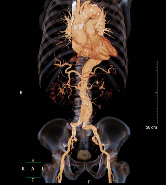 angiografía por ct de renderizado 3d de aorta abdominal con imágenes de rayos x muestra aneurisma de aorta abdominal. - computed fotografías e imágenes de stock