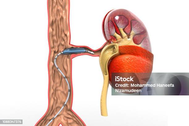 Stent Angioplasty Peripheral Artery Disease Stock Photo - Download Image  Now - Artery, Illness, Anatomy - iStock