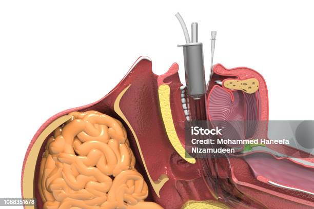 Endotracheal Intubation Human Head Cross Section Stock Photo - Download Image Now - Larynx, Protective Face Mask, Patient