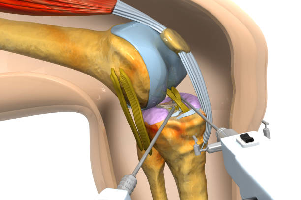 人間の膝の手術の 3 d のレンダリング - men anatomy the human body body ストックフォトと画像