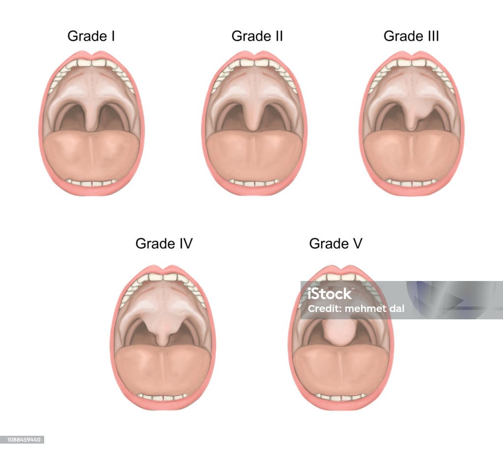 Uvula Incision Uvula Anatomia Uvula What Is UPPP Surgery?