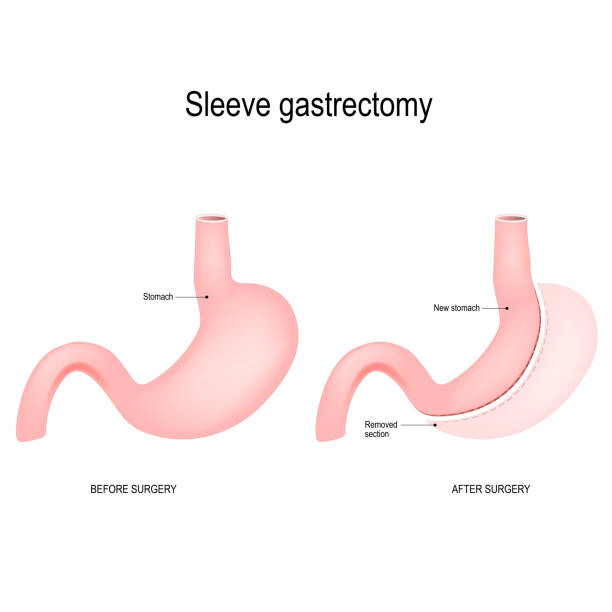 illustrazioni stock, clip art, cartoni animati e icone di tendenza di gastrectomia a manica verticale - piloro