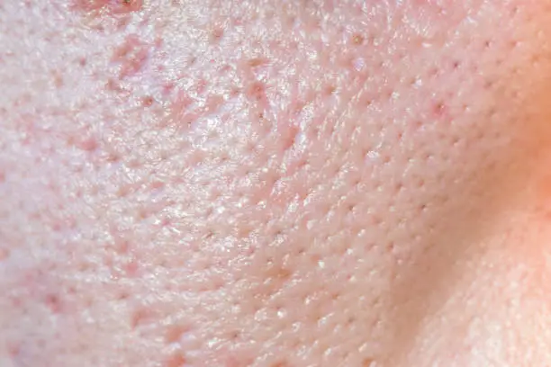 large pores, close up has skin problem, oily skin, whitehead and blackhead pimple from not take care for a long time.