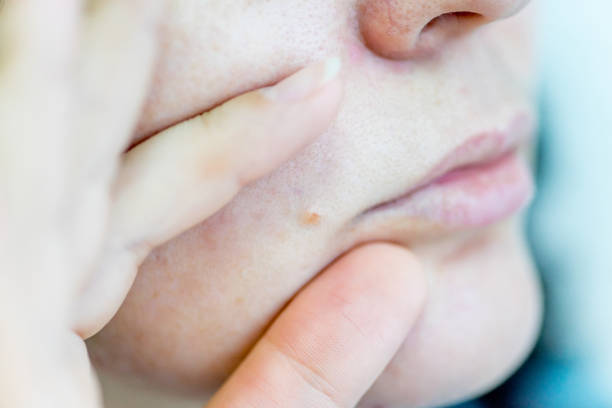 istock a birthmark or a mole on a woman skin 1088901446