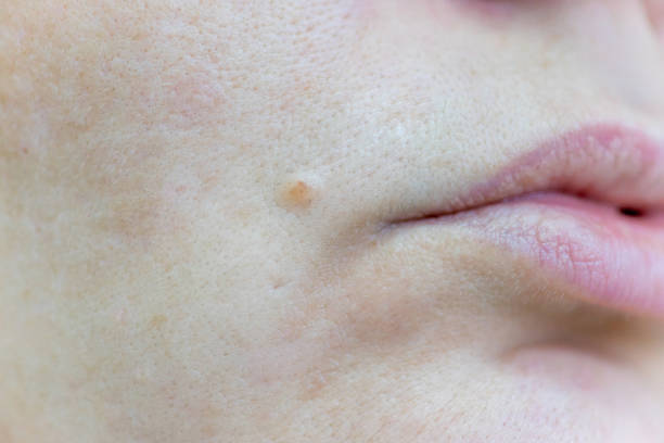 istock a birthmark or a mole on a woman skin 1088901452