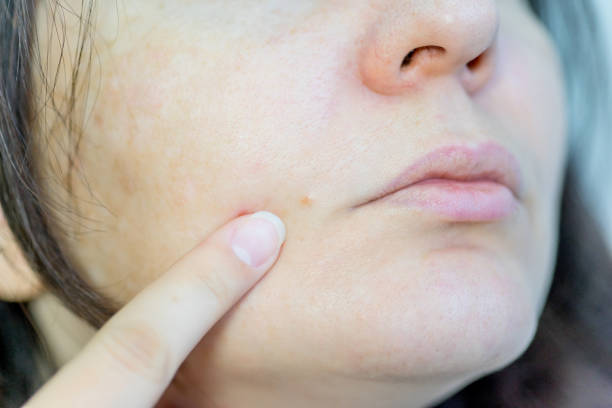 istock a birthmark or a mole on a woman skin 1088901486