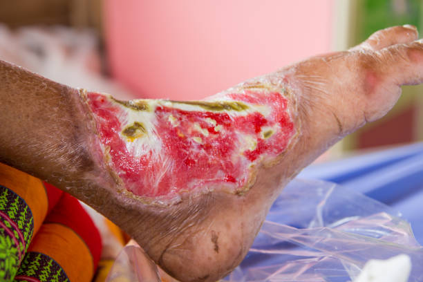 infected wound of diabetic foot infected wound of diabetic foot infected wound stock pictures, royalty-free photos & images