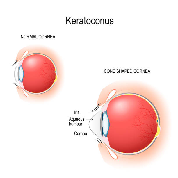 illustrations, cliparts, dessins animés et icônes de kératocône. cornée normale et la cornée en forme de cône. - choroid