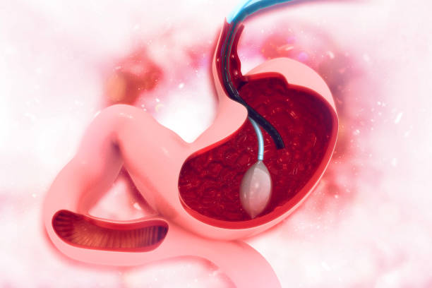 istock stomach Endoscopy. Gastric Ballon Inside a Stomach 1089692582