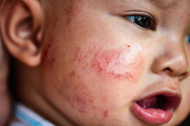 allergie bébé éruption cutanée sur la face / visage de fille de bébé maladie sec démangeaisons de la peau et de la lésion - eczema photos et images de collection