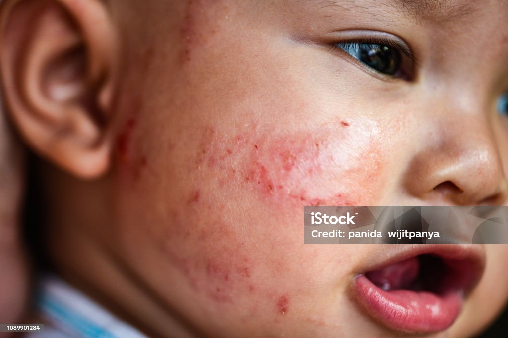 Gedetailleerd Reis evolutie Uitslag Baby Allergie Op Gezicht Ziekte Baby Meisje Gezicht Droge Huid Jeuk  En Laesie Stockfoto en meer beelden van Eczeem - iStock
