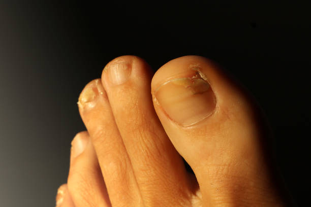istock Close up feet with bad nails 1090020270