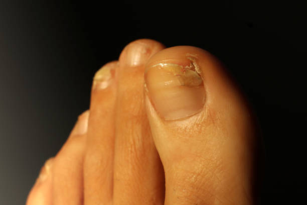 istock Close up feet with bad nails 1090020492