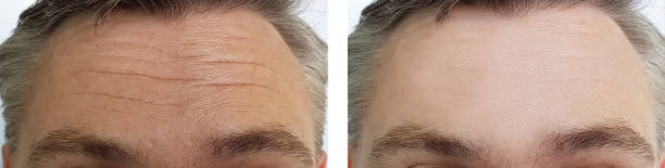 male forehead wrinkles before and after procedures male forehead wrinkles before and after procedures botox before and after stock pictures, royalty-free photos & images