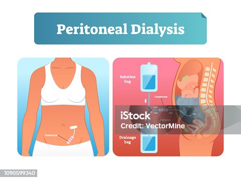 istock Peritoneal dialysis vector illustration. Labeled method to exchange fluids. 1090599340