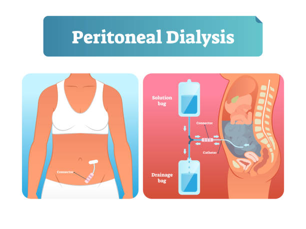 Peritoneal dialysis vector illustration. Labeled method to exchange fluids. Peritoneal dialysis vector illustration. Labeled scheme with method to exchange fluids after surgery. Isolated internal catheter system explanation diagram. Medical kidney failure solution infographic kidney failure stock illustrations