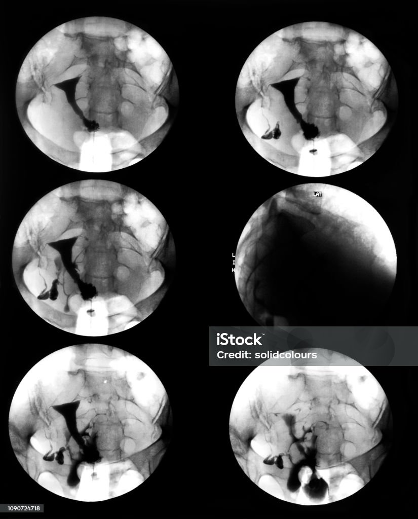 Internal Rupture Internal Bleeding Stock Photo - Download Image Now - Anatomy ...