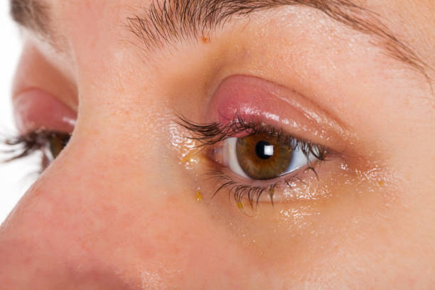 istock Upper eyelid infection - chalazion 1090800408