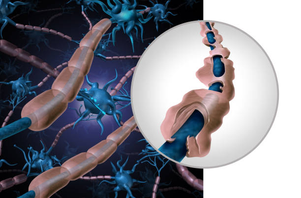 Multiple Sclerosis Myelin Disease Multiple sclerosis myelin disease or MS autoimmune disorder with healthy nerve with exposed fibre with scarrred cell sheath loss as a 3D illustration. medulla stock pictures, royalty-free photos & images