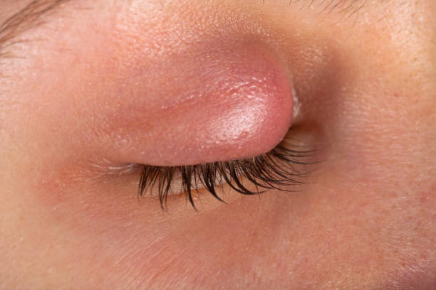 istock Hordeolum on upper eyelid. Viral infection 1091254964