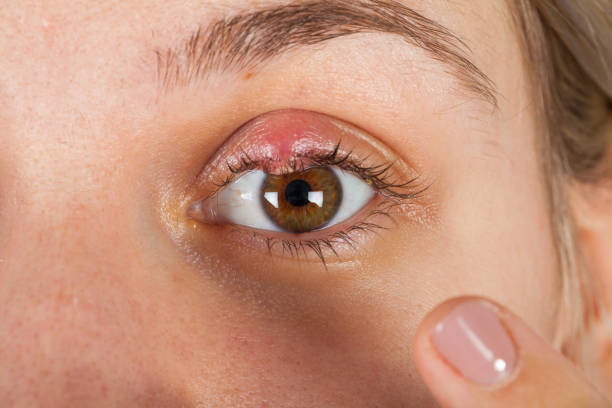 istock Hordeolum on upper eyelid. Viral infection 1091255338
