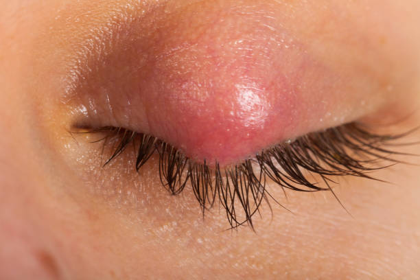 istock Hordeolum on upper eyelid. Viral infection 1091255412