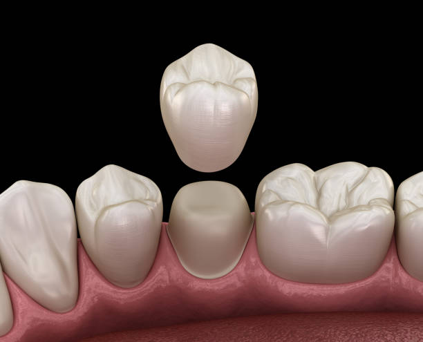 istock Dental crown premolar tooth assembly process. Medically accurate 3D illustration of human teeth treatment 1091290614