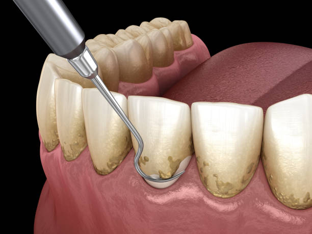 istock Oral hygiene: Scaling and root planing (conventional periodontal therapy). Medically accurate 3D illustration of human teeth treatment 1091294754