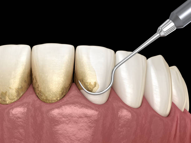 istock Oral hygiene: Scaling and root planing (conventional periodontal therapy). Medically accurate 3D illustration of human teeth treatment 1091294788
